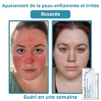 Stylo Laser Anti-Grains de Beauté & Verrues