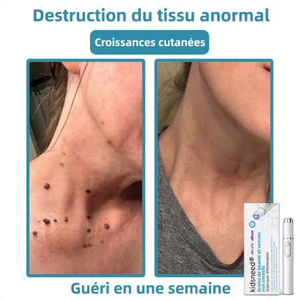 Stylo Laser Anti-Grains de Beauté & Verrues